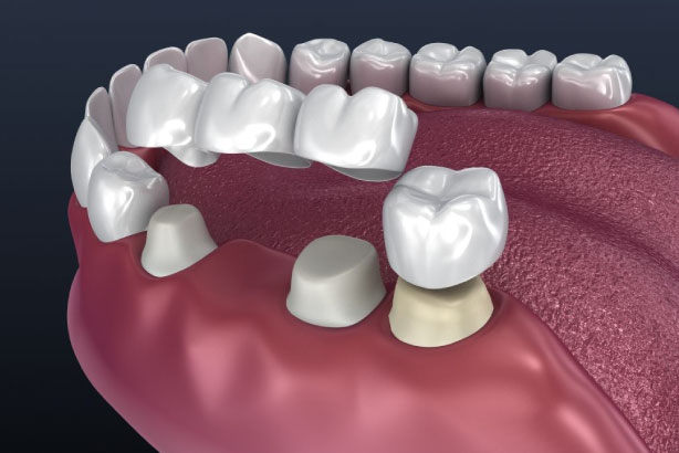 Dental Crown/Bridge