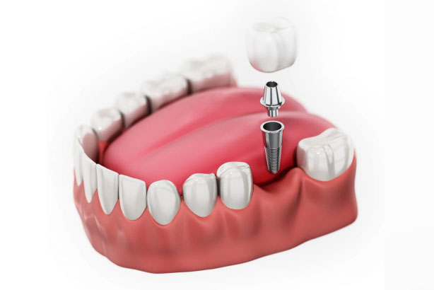 Dental Implants