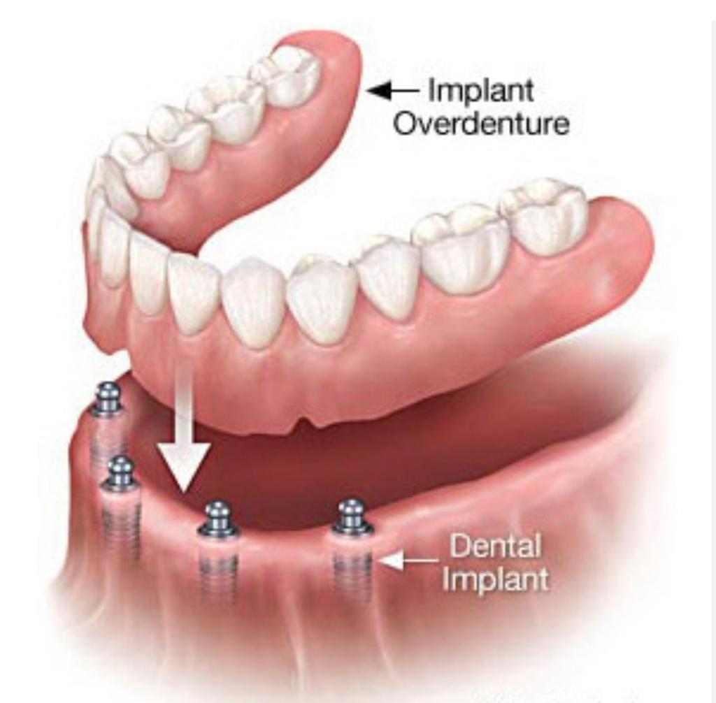Implant Overdenture